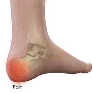 Heel Spurs: Causes, Symptoms, and Treatment