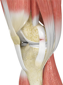 Medial Collateral Ligament MCL Injury Sydney, NSW